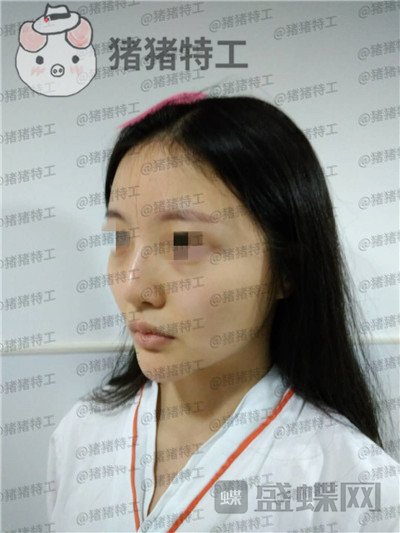 上海九院李茂群隆鼻案例价格分享，垫了鼻子法令纹竟然神奇的消失了！