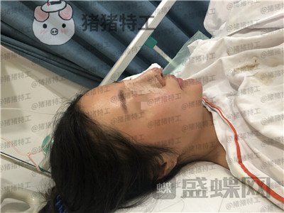 上海九院李茂群隆鼻案例价格分享，垫了鼻子法令纹竟然神奇的消失了！