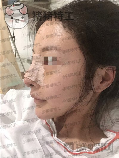 上海九院李茂群隆鼻案例价格分享，垫了鼻子法令纹竟然神奇的消失了！