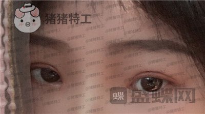 西安高一生刘军双眼皮案例价格分享，朋友说我割了还不如不割？