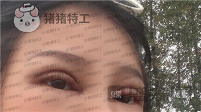 西安高一生刘军双眼皮案例价格分享，朋友说我割了还不如不割？