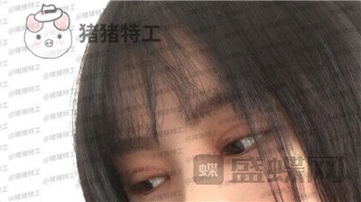 西安高一生刘军双眼皮案例价格分享，朋友说我割了还不如不割？