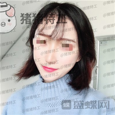 武汉华美马行鼻部手术案例价格分享，优惠的价格竟然可以做的这么完美！