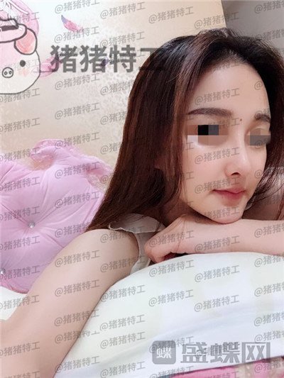 福州爱美尔张胜利鼻部手术案例价格分享，排预约等了这么久做成这样真的值了！