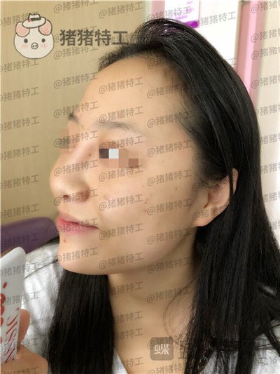 云南华美美莱洪晓娅鼻部手术案例价格分享，果然鼻子高了不化妆都很好看！