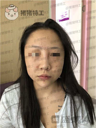 云南华美美莱洪晓娅鼻部手术案例价格分享，果然鼻子高了不化妆都很好看！