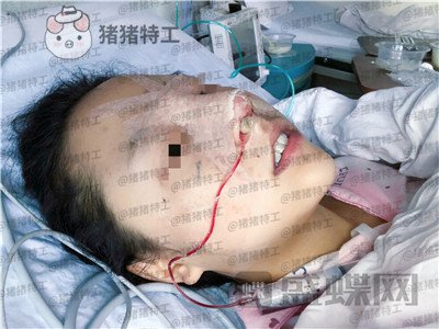 云南华美美莱洪晓娅鼻部手术案例价格分享，果然鼻子高了不化妆都很好看！