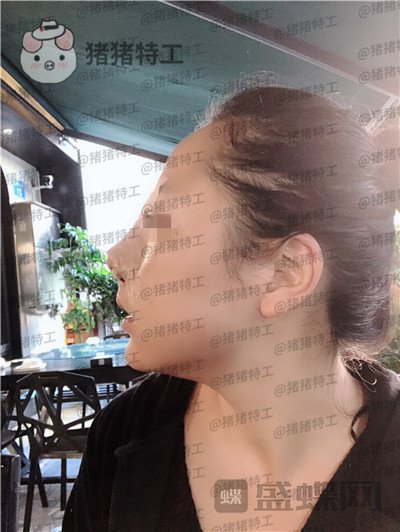 云南华美美莱洪晓娅鼻部手术案例价格分享，果然鼻子高了不化妆都很好看！