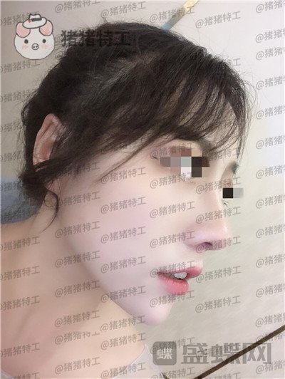 云南华美美莱洪晓娅鼻部手术案例价格分享，果然鼻子高了不化妆都很好看！