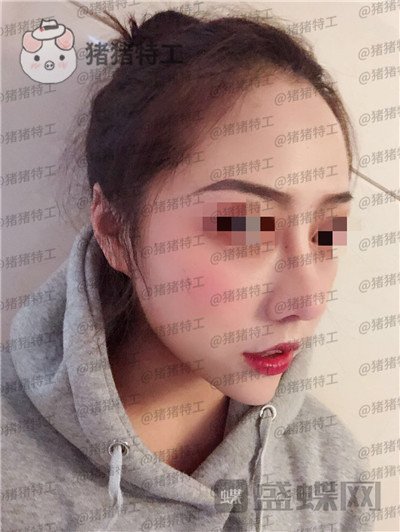 云南华美美莱洪晓娅鼻部手术案例价格分享，果然鼻子高了不化妆都很好看！