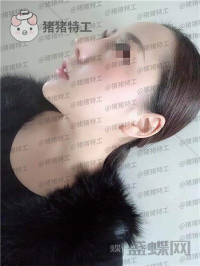 云南华美美莱洪晓娅鼻部手术案例价格分享，果然鼻子高了不化妆都很好看！