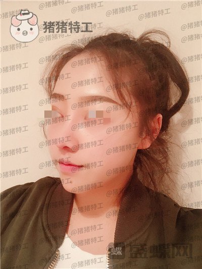 云南华美美莱洪晓娅鼻部手术案例价格分享，果然鼻子高了不化妆都很好看！