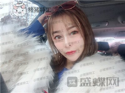 重庆铂生杜亚旭隆鼻案例价格分享，路人变女神一个鼻子就够了？