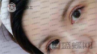 上海九院苏婷双眼皮修复案例价格分享，之前眼睛不对称很难看终于有救了！