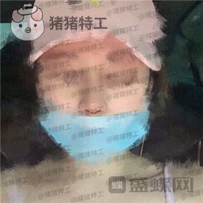 北京八大处王欢鼻修复案例价格分享，这么失败的鼻子以为没救了多谢医生妙手回春~