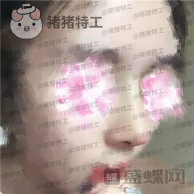 北京八大处王欢鼻修复案例价格分享，这么失败的鼻子以为没救了多谢医生妙手回春~