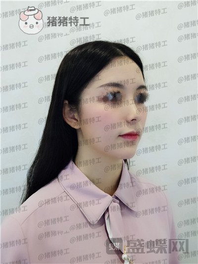 南京美贝尔黄名斗鼻部手术案例价格分享，做完受到太多赞美整个人自信了很多~