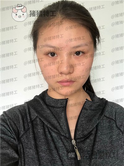 兰州亚韩李军梅隆鼻案例价格分享，做耳软骨隆鼻是一种什么体验？