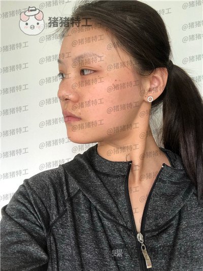 兰州亚韩李军梅隆鼻案例价格分享，做耳软骨隆鼻是一种什么体验？