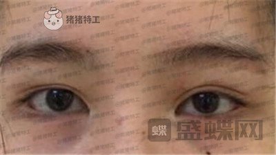 杭州伊琳毛琪双眼皮修复案例价格分享，这个妹子是iu本人吗目光神似~