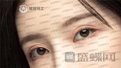 杭州伊琳毛琪双眼皮修复案例价格分享，这个妹子是iu本人吗目光神似~