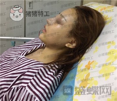 邯郸雅丽刘雅丽隆鼻案例价格分享，做完秒变小仙女好看的鼻子装嫩神器~