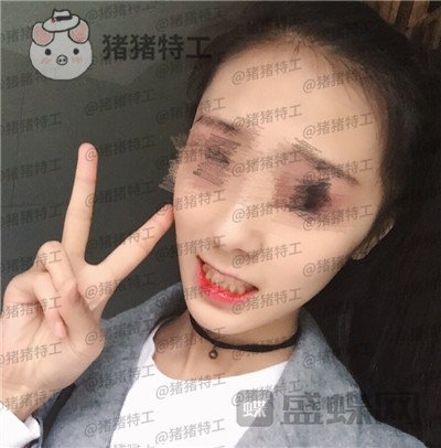 成都博爱李竞男牙齿美白案例价格分享，黄牙妹做完张口大笑再也不自卑~