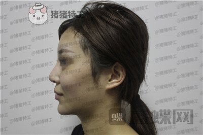 成都西区医院肖凌鼻修复案例价格分享，宝藏女孩做完很御姐范~