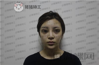 成都西区医院肖凌鼻修复案例价格分享，宝藏女孩做完很御姐范~