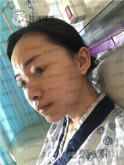 广州美莱张毓面部填充案例价格分享，曾经显凶的脸现在都夸我萌萌哒可爱~