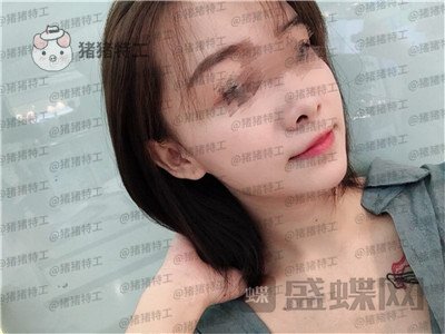 广州美莱张毓面部填充案例价格分享，曾经显凶的脸现在都夸我萌萌哒可爱~