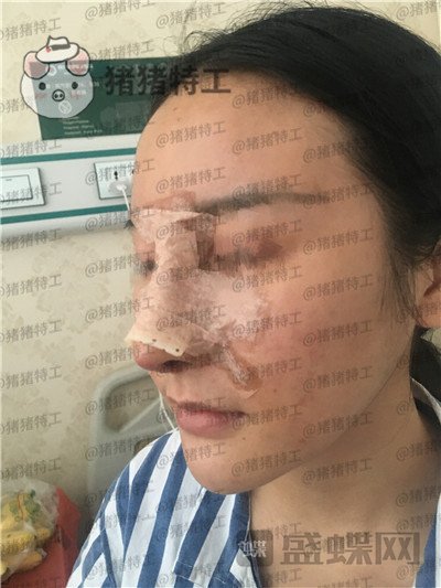 成都军大文科鼻部手术隆鼻案例价格分享，侧颜杀的女神正面同样很迷人~