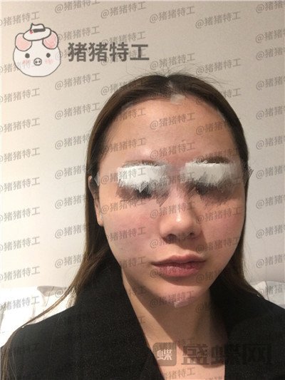 西安医学院陈杰面部填充案例价格分享，老阿姨蜕变小仙女毫无夸张说辞~