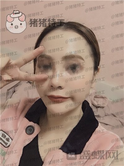 西安医学院陈杰面部填充案例价格分享，老阿姨蜕变小仙女毫无夸张说辞~