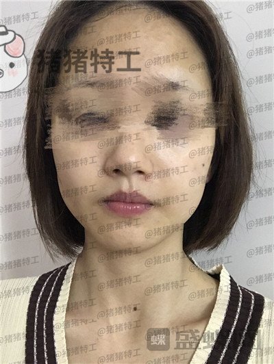 成都美容整形李静面部填充案例价格分享，感觉没果医生说两三个月才能看出来。