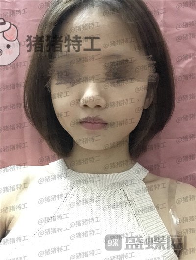 成都美容整形李静面部填充案例价格分享，感觉没果医生说两三个月才能看出来。