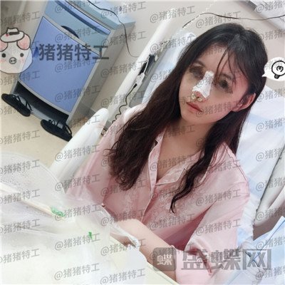 苏州美莱吴蓉鼻部手术案例价格分享，隆鼻一时爽一直美丽一直爽~