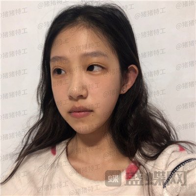 杭州美莱韩超鼻部手术案例价格分享，刚做完像热巴的鼻子好喜欢~