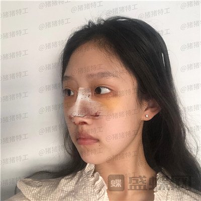 杭州美莱韩超鼻部手术案例价格分享，刚做完像热巴的鼻子好喜欢~