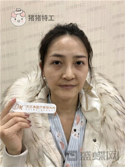 重庆天艺美徐志强面部填充案例价格分享，这个果说阿姨变少女完全不夸张哦。