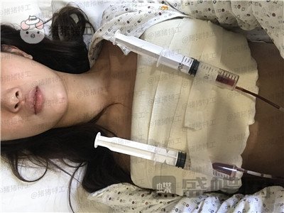 南京美贝尔黄名斗隆胸案例价格分享，变身性感女神婚后生活真美好~