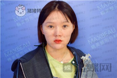 重庆精美田永华鼻部手术案例价格分享，短发女孩配好看的鼻子精致感get~