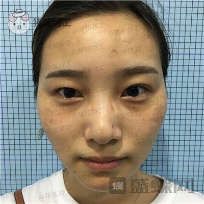 杭州格莱美王馨婉双眼皮案例价格分享，很可爱的眼睛真的好感度倍增~