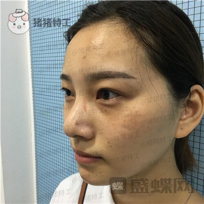 杭州格莱美王馨婉双眼皮案例价格分享，很可爱的眼睛真的好感度倍增~