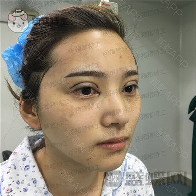 杭州格莱美王馨婉双眼皮案例价格分享，很可爱的眼睛真的好感度倍增~