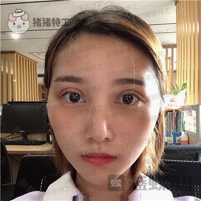 杭州格莱美王馨婉双眼皮案例价格分享，很可爱的眼睛真的好感度倍增~