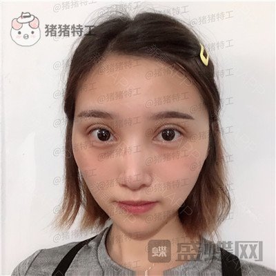 杭州格莱美王馨婉双眼皮案例价格分享，很可爱的眼睛真的好感度倍增~