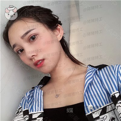 杭州格莱美王馨婉双眼皮案例价格分享，很可爱的眼睛真的好感度倍增~