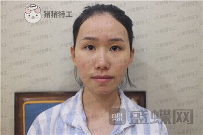 陕西韩媚王仁根面部填充案例价格分享，年轻了不止十岁感受一下~