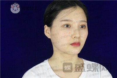 四川友谊张立天颧骨整形案例价格分享，阿姨变小仙女蜕变的很惊艳~